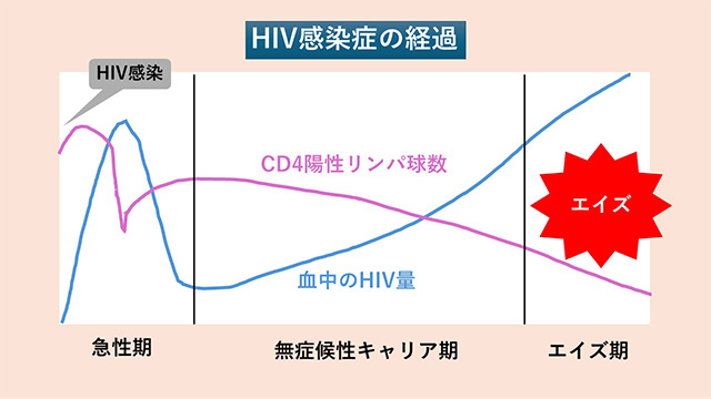 HIV感染症の経過を示すグラフ。急性期、無症候性キャリア期、エイズ期の各段階が示されている。